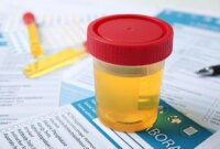 Tes Urin Sederhana Dapat Merevolusi Diagnosis dan Pengobatan Kanker Kandung Kemih

